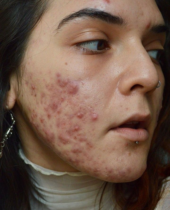 ニキビ跡にさよなら！美肌を手に入れる第一歩を踏み出そう