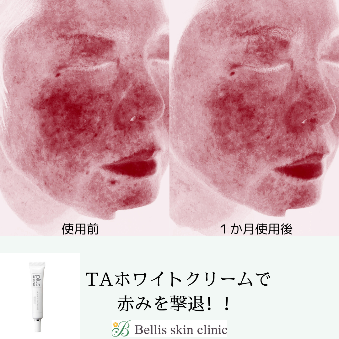 炎症と敏感肌の関連性