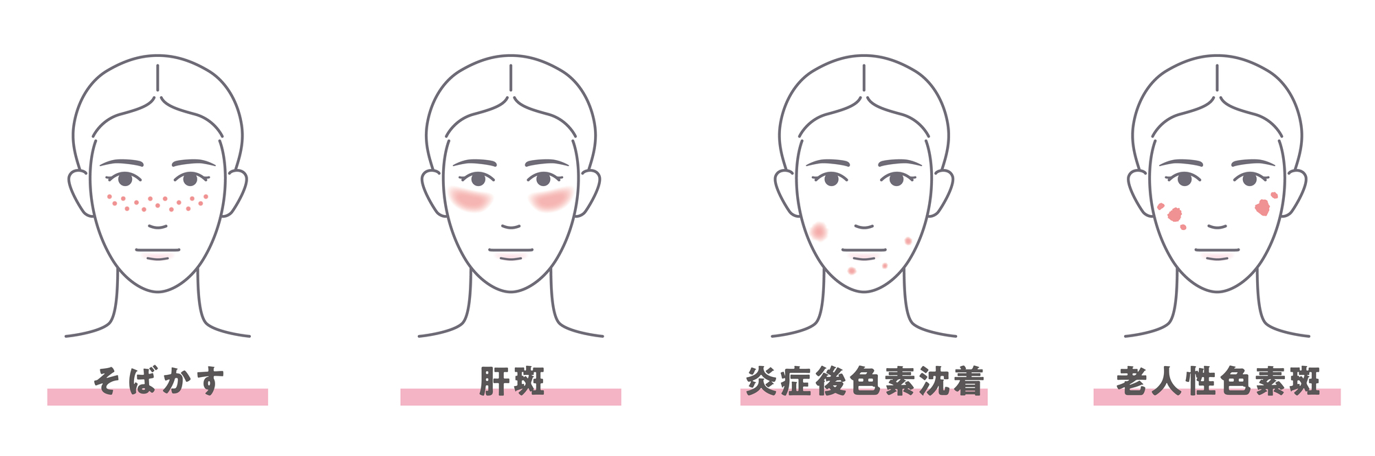 肝斑の病態とその原因