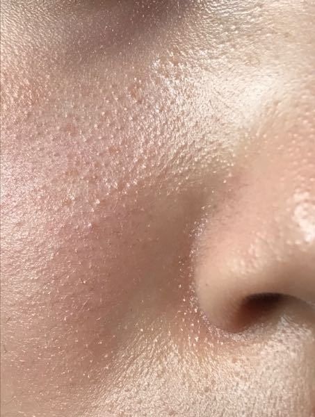 皮脂コントロールの重要性